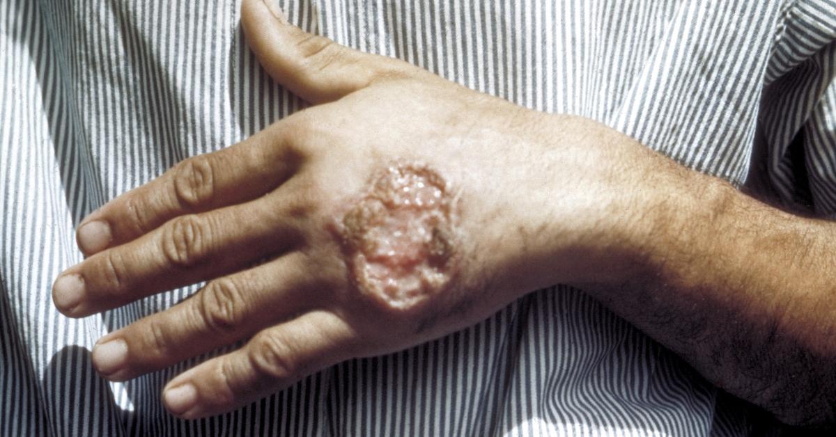 A leishmaniasis sore on a man's hand.